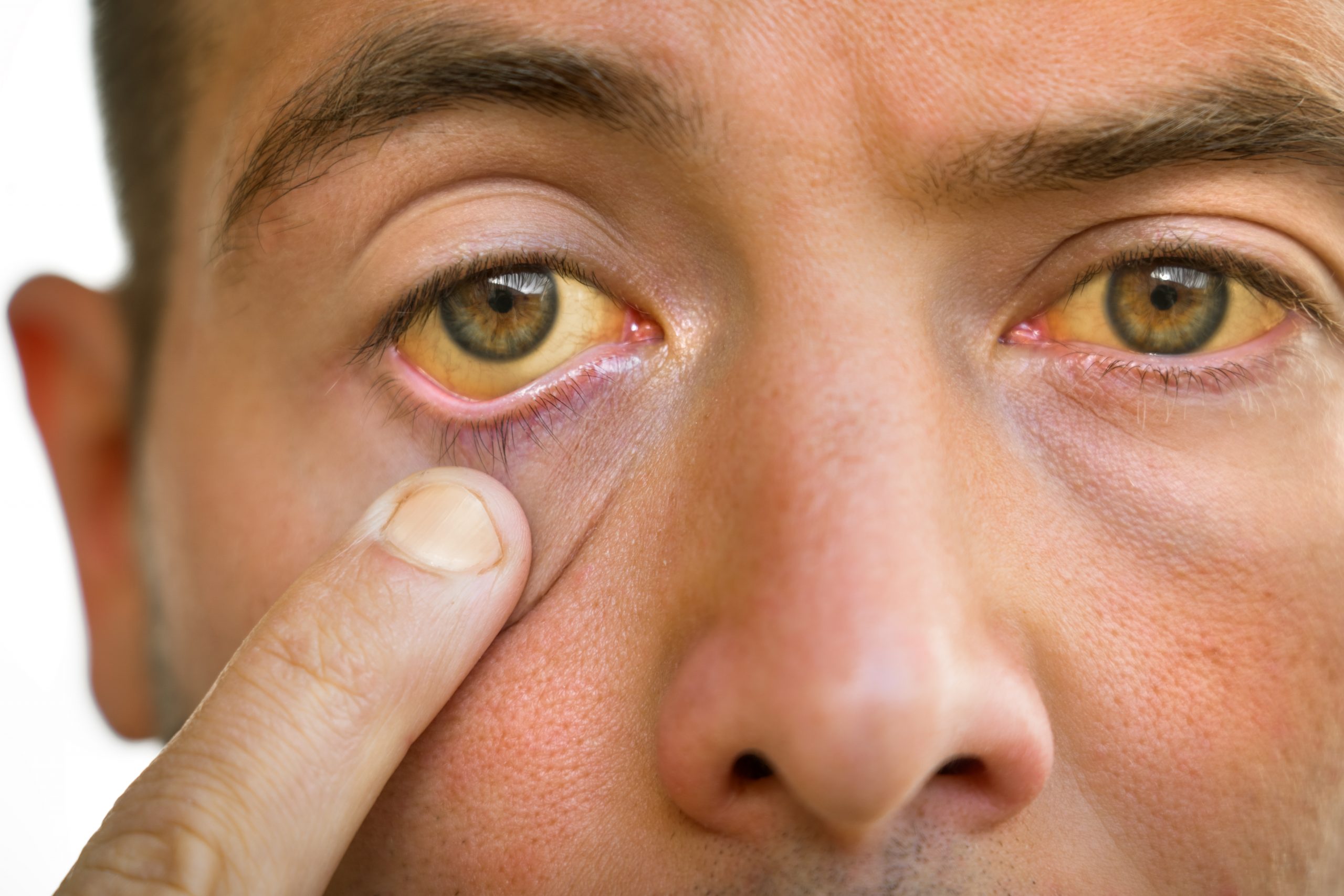 Симптомы гепатита а у взрослых. Пожелтение склер гепатит. Жёлтые глаза у человека.